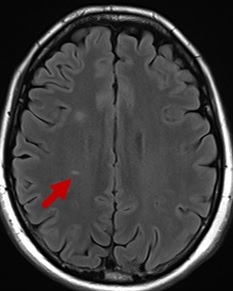 頭部MRI（FLAIR）